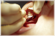 現在残っている歯の治療